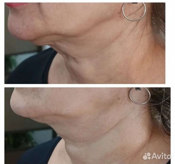 СМАС лифтинг