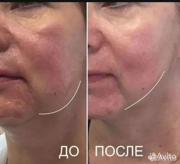 Rf-lifting лица, шеи, декольте