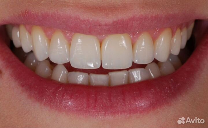 Коронки изготовление