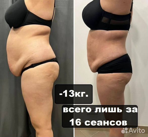 LPG массаж. Коррекция фигуры. Похудение