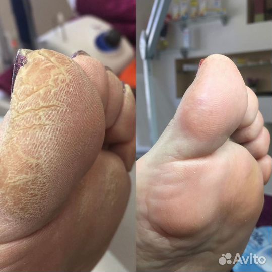 Педикюр с выездом на дом