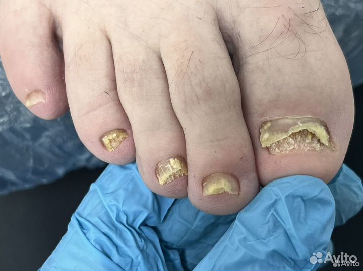 Подолог, медицинский педикюр, педикюр
