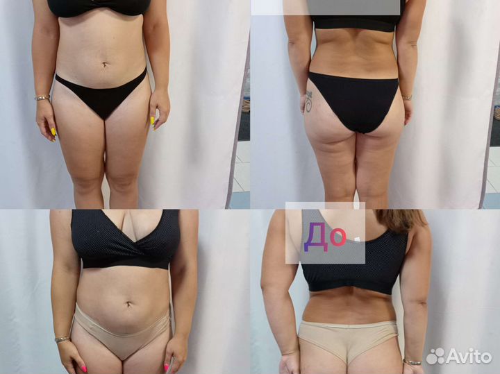 LPG массаж коррекция фигуры