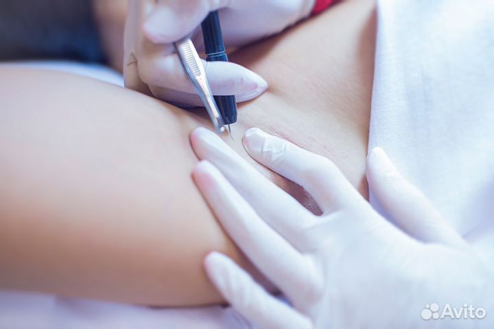 Электроэпиляция