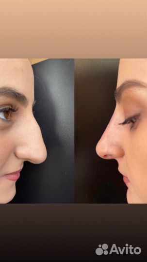 Требуются модели на всю контурную пластику