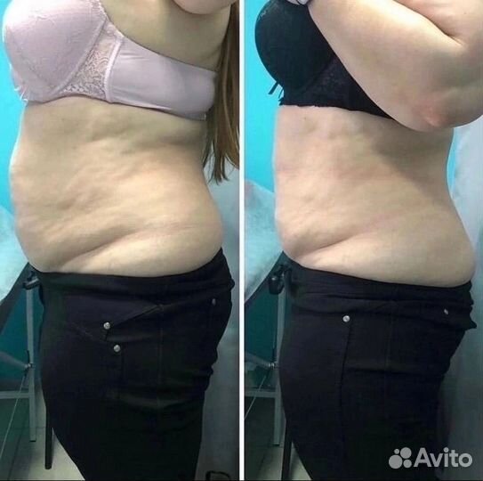 Криолиполиз/ безоперационная липосакция