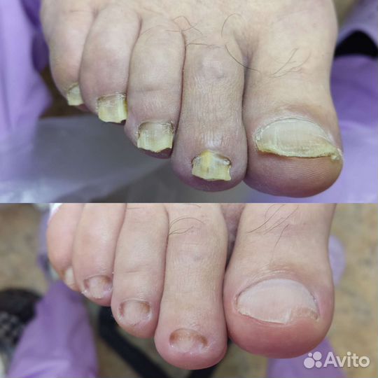 Педикюр, подолог