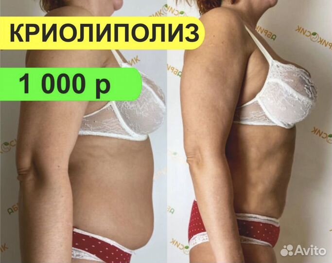 Криолиполиз