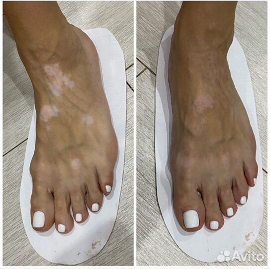 Лосьон - автозагар маскирует витилиго