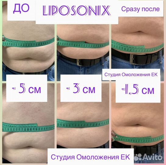 Liposonix Живот+ Бока