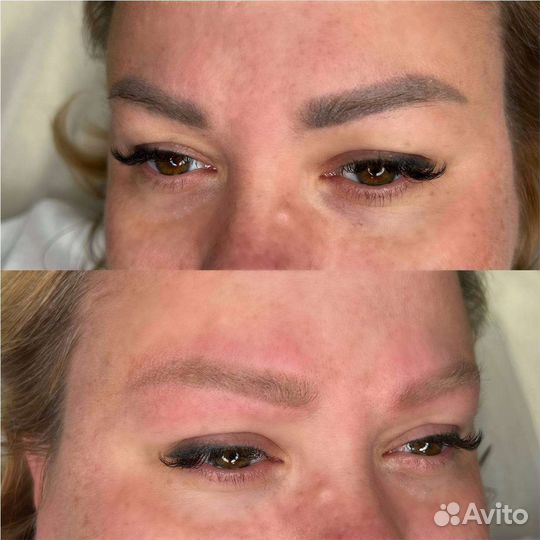 Удаление татуажа лазером модели