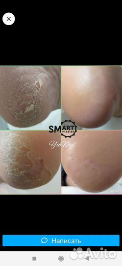 Подолог, лечебный педикюр с выездом на дом