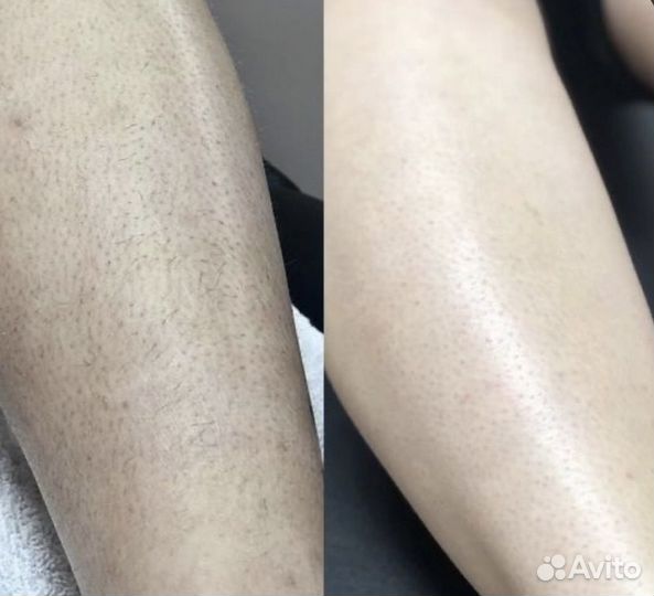 Лазерная эпиляция диодный лазер