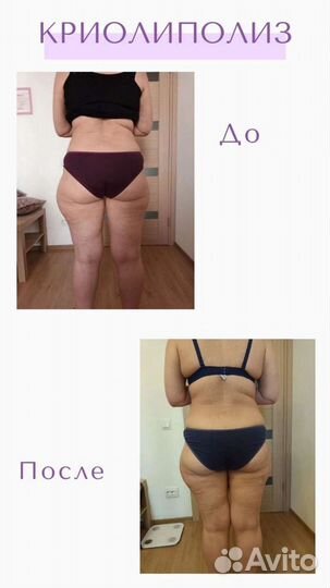 Криолиполиз