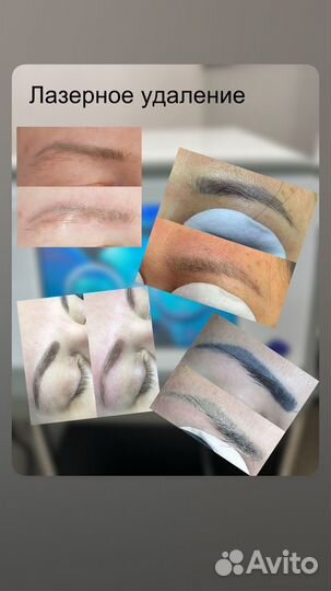 Перманентный макияж Удаление тату