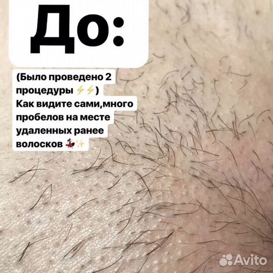 Электроэпиляция женская