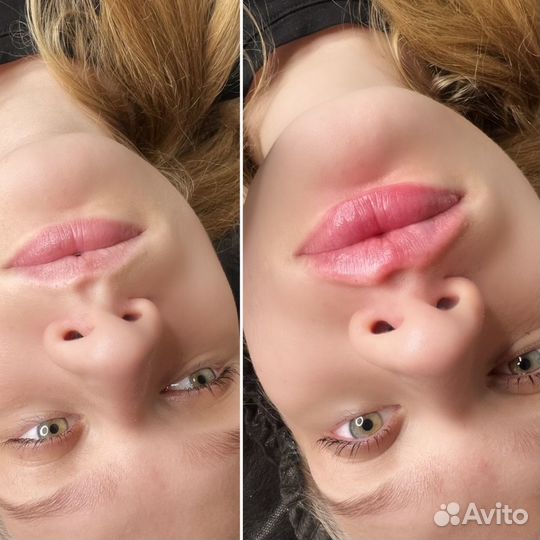 Увеличение губ