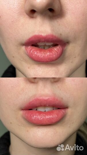 Удаление татуажа лазером