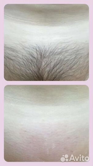 Шугаринг, Ваксинг