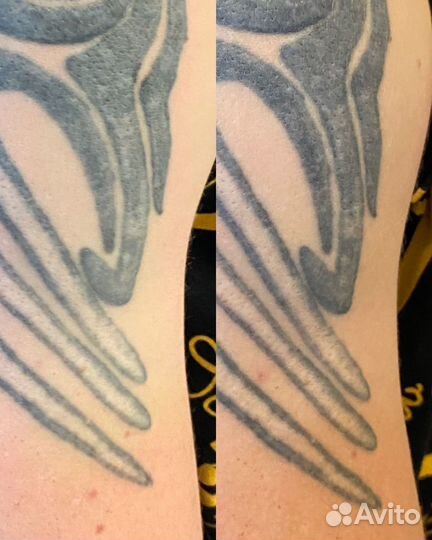 Удаление тату и татуажа