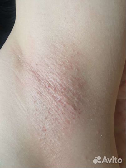 Депиляция воском