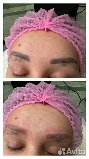 Лазерная эпиляция: бакенбарды