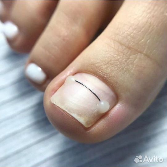 Установка титановой нити