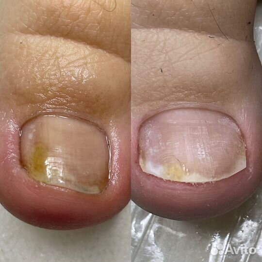 Педикюр подолог