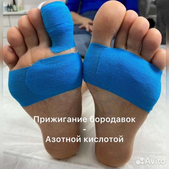 Медицинский педикюр подолог