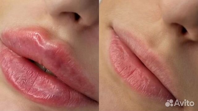 Аугментация губ, BioRepeelcl3, липолитик