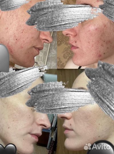 Болтушка Skin Care от проблемной кожи