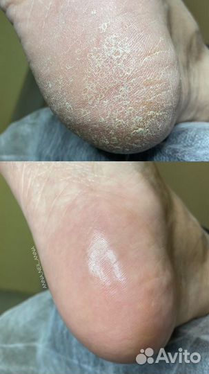 Подолог - Smart-педикюр ангарск