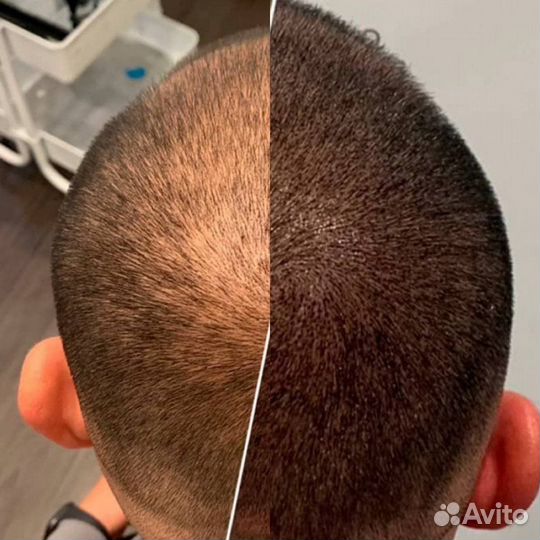 Трихопигментация мужская загущение волос