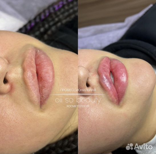 Увеличение губ, увлажнение 0,5мл; 1мл