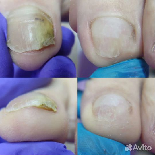 Педикюр, подолог