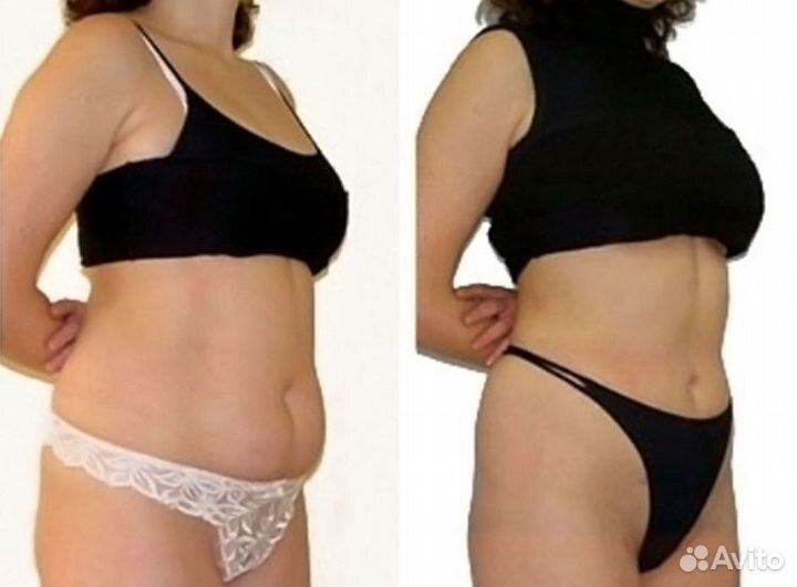 LPG массаж в Новороссийске