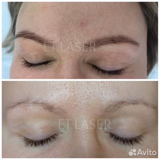 Удалить татуаж