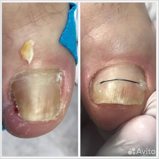 Подологический педикюр