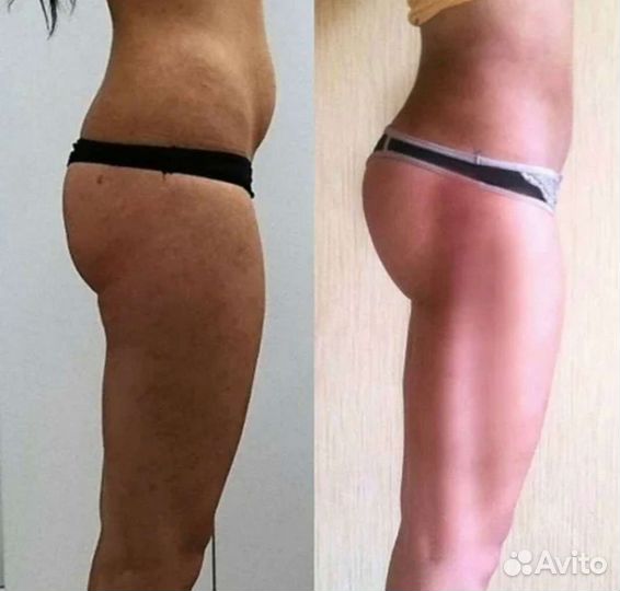 Emsculpt процедура (прокачка мышц )