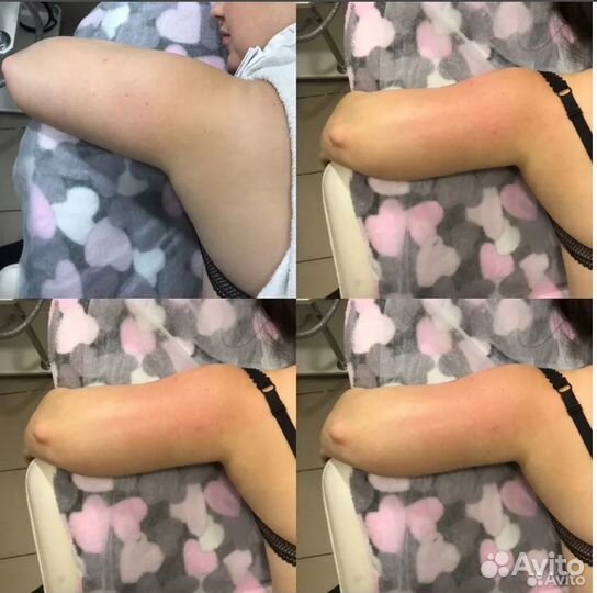 Стройные руки, удаление жира навсегда в Перми