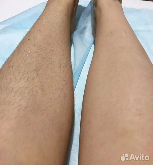 Восковая депиляция и шугаринг