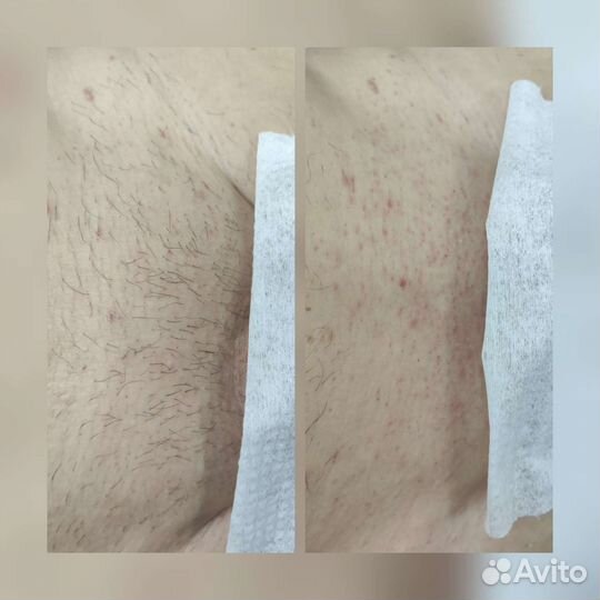 Депиляция воском: глубокое бикини