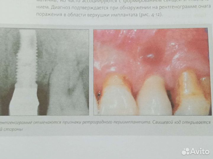 Периимплантит