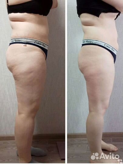 Вакуумный массаж