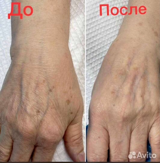 Плазмолифтинг