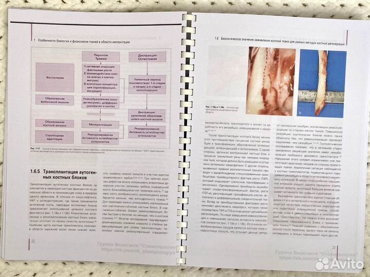Регенеративные методы в имплантологии
