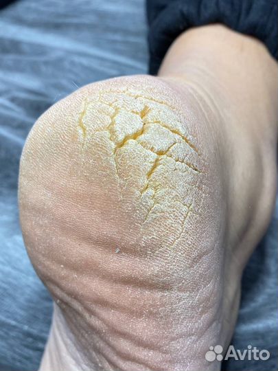 Сложный медицинский педикюр с выездом на дом