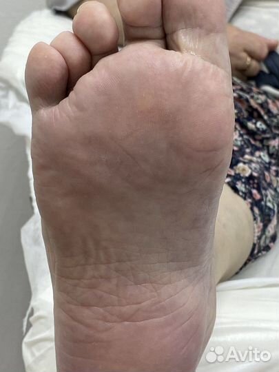 Подолог/Педикюр/Вросший ноготь/Мозоль