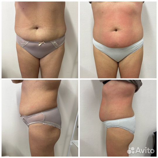 Коррекция фигуры /Lpg массаж/Кавитация/ Rf-лифтинг