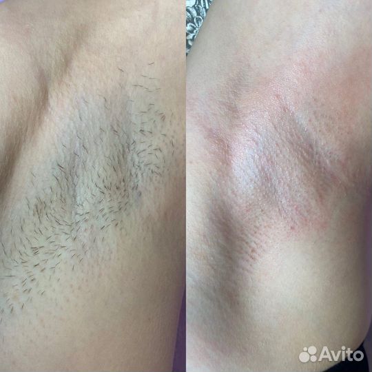 Восковая депиляция,шугаринг